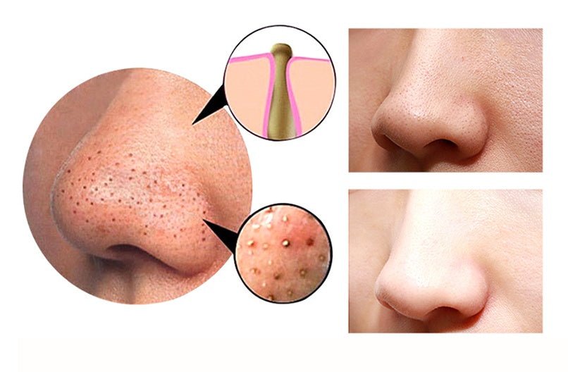 Exclusive 4 in 1 Body Guasha Cupping Blackhead Remover — Black — Lifestyle View