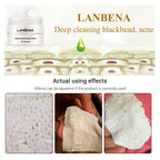 Exclusive Blackhead Nasal Mask — Pore fluid — Top View